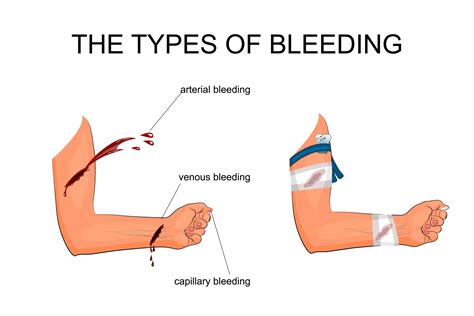 Different Types Of Bleeding