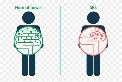 Short Bowel Syndrome - Short Bowel Syndrome Patient, HD Png Download ...