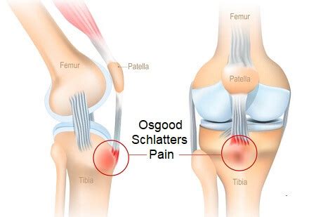 Pain Below The Knee: Causes & Treatment Of Pain Under The Knee