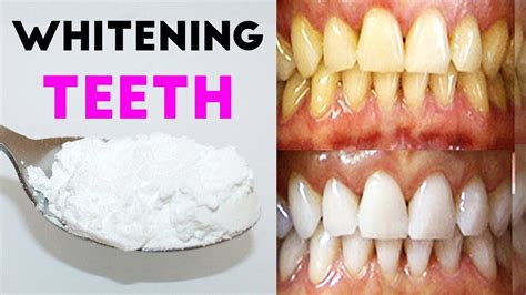 Pin on Whitening Teeth With Baking Soda - Teeth Whitening at Home