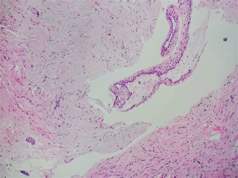 Globulomaxillary Cyst Histology