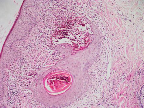 Eosinophilic Pustular Folliculitis Histology