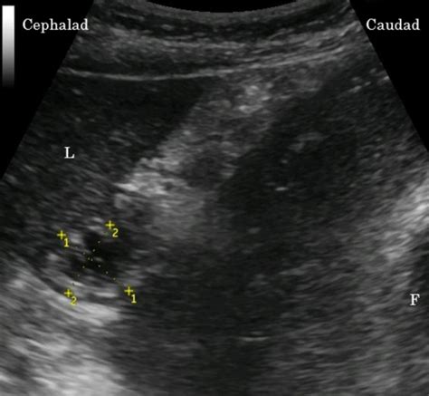 Ultrasonographic image of the gastric antrum The figure demonstrates ...