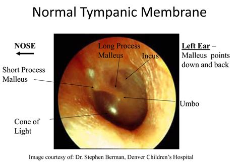 Normal Tympanic Membrane - Critical Care Practitioner