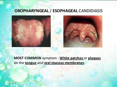 Candidiasis, Moniliasis, Oral thrush, Yeast infections