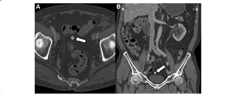 Chronic calcified, amputated epiploic appendage in an 81-year-old man.... | Download Scientific ...