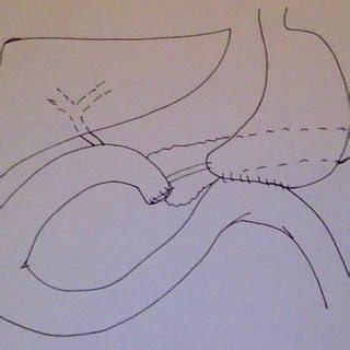 Omental Patch Repair | Download Scientific Diagram