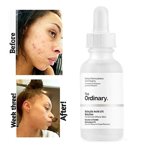 The Ordinary Salicylic Acid 2% Solution – Simply Glow