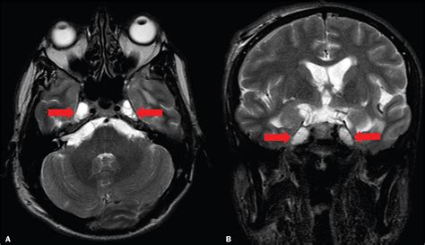 Idiopathic Intracranial Hypertension Mri