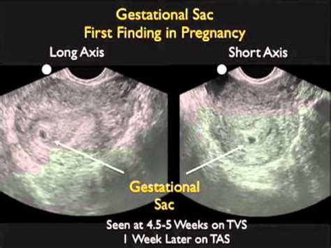 Single Live Intrauterine Pregnancy Meaning In Tamil - PregnancyWalls