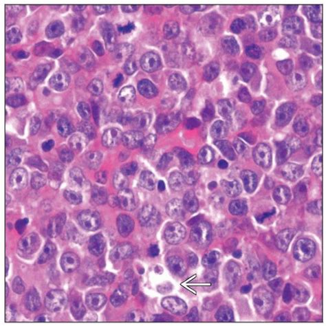 Diffuse Large B-cell Lymphoma, NOS, Immunoblastic | Basicmedical Key