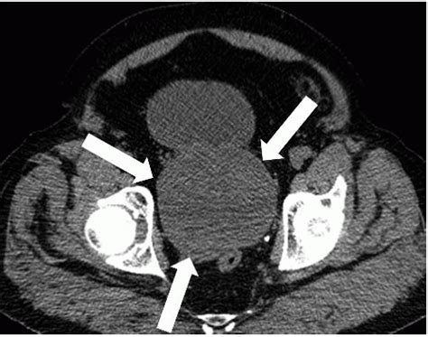 Prostate and Seminal Vesicles | Radiology Key