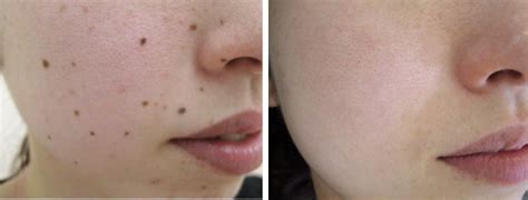 Mole Removal - luciemedispa.com