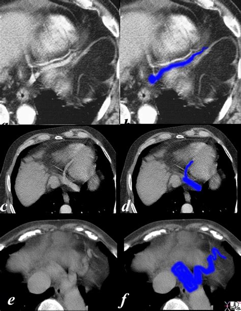 Venous Drainage | Heart