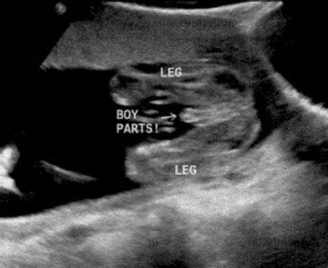 Baby ultrasound of a boy. | Boy ultrasound, Boy ultrasound pictures, Baby ultrasound