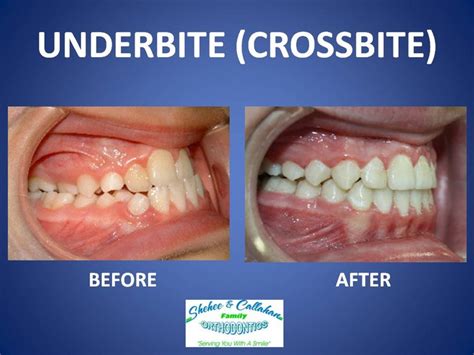 Braces before and after - underbite/crossbite | Crossbite, Invisalign ...