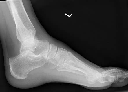 Calcaneus Fracture Treatment