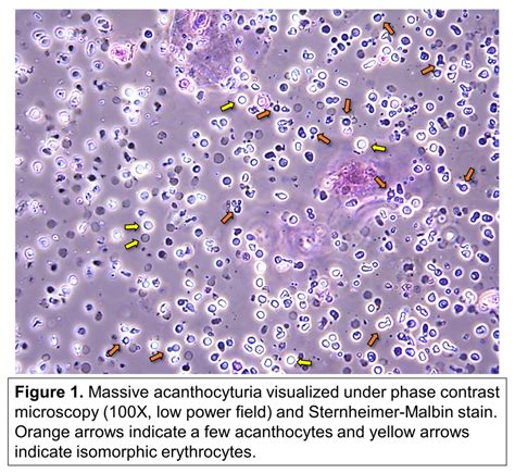 50 best ideas for coloring | Red Blood Cells In Urinalysis