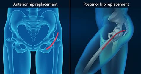 Is anterior hip replacement better?