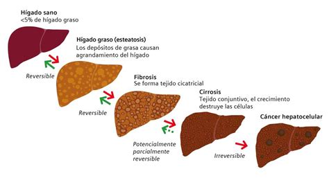 Esteatosis hepática no alcohólica - Siemens Healthineers Chile