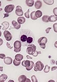 Medical Treatment Pictures-for Better Understanding: Myelodysplastic ...