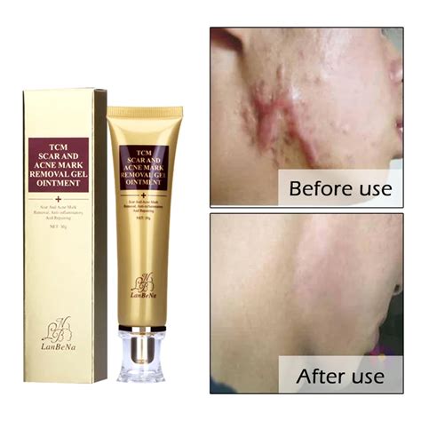 Lady Acne Scar Cream Ginseng Essence Anti Acne Remover Cream Spots Stretch Marks Remove Scar ...