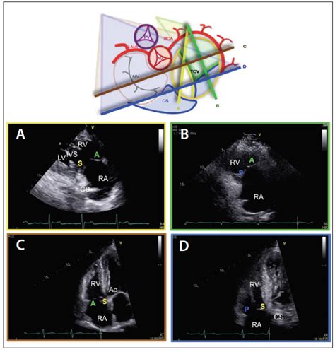 Echocardiography for Tricuspid Valve Intervention - Cardiac Interventions Today