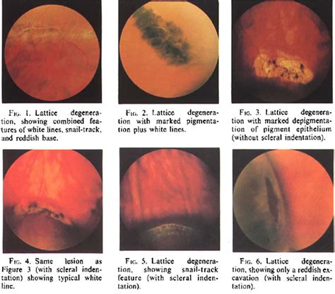 Lattice degeneration of retina causes, symptoms, diagnosis, prognosis & treatment