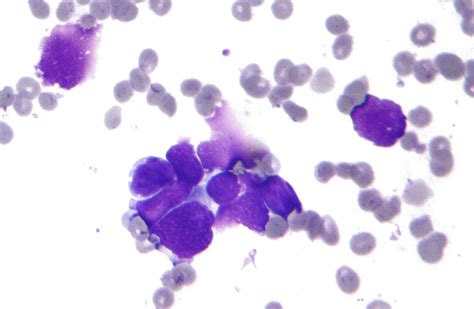 Extensive Stage Small Cell Lung Cancer