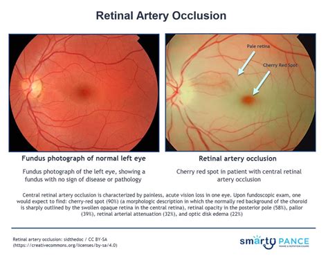 Central Retinal Artery Occlusion Anatomy