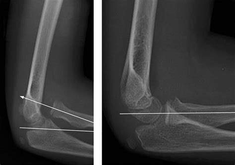 “No bony injury seen”: radial head dislocation | Emergency Medicine Journal