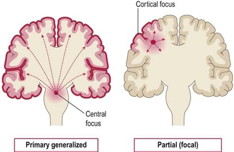 Epilepsy | Clinical Gate