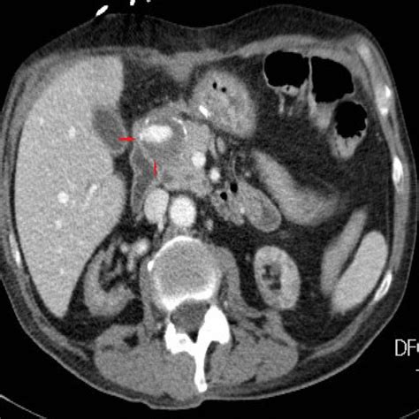 Contrast-enhanced computed tomography (axial view) showing contrast ...