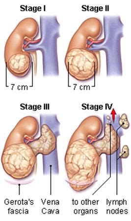 Kidney Cancer