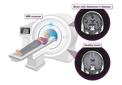 All you need to know about brain scans and dementia - Alzheimer's ...