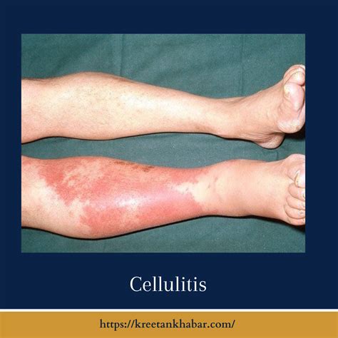 understanding-cellulitis-causes-symptoms 2023