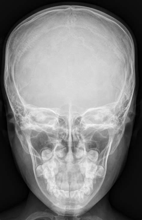 X Ray Cranium Indications soft Tissue Sweling - Radiology Imaging