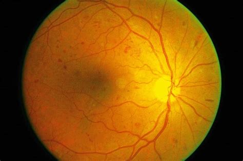 Blindness Due to Diabetic Retinopathy Surges Worldwide | Florida Eye ...