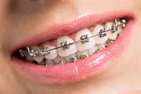 Clear Braces Newport Beach 92660 to straighten your teeth