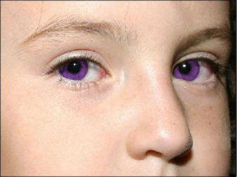 Alexandria Genesis is a genetic disorder that causes peoples eyes to be purple. Purple Eyes ...