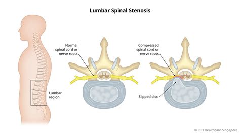 Great Knowledge | Spinal Stenosis Causes Symptoms And Treatment ...