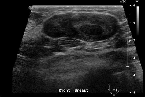 Fibroadenoma of breast | Image | Radiopaedia.org