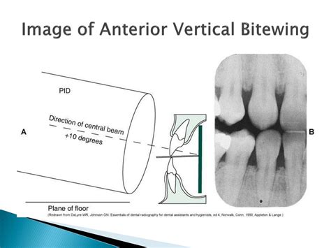 Dental Code For 4 Bitewings at Patricia Ortiz blog