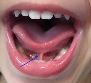 Tongue-Tie | The Dental Arcade – Blog