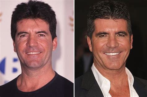 Simon Cowell before and after plastic surgery (26) | Celebrity plastic surgery online