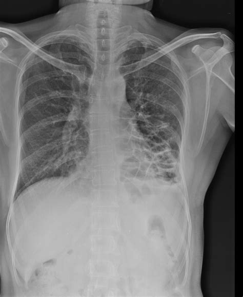 Radiografía de tórax que muestra un nódulo pulmonar derecho. Download ...