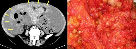 Omental Cake | Epomedicine