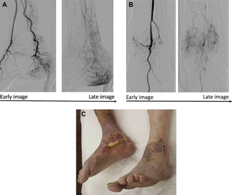 Capillary-venule malformation is a microfistulous variant of ...