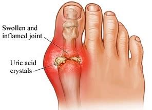 Evidence-based Physiotherapy for Gouty Arthritis