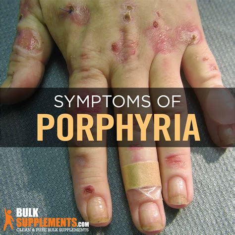 Porphyria: Symptoms, Causes & Treatments